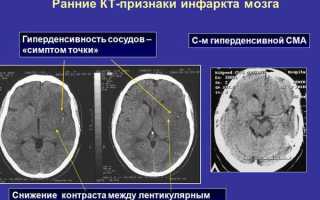 Инфаркт мозга