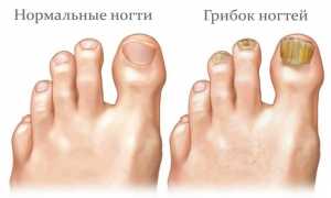 Как выглядит грибок ногтей на ногах: симптомы, его виды и стадии