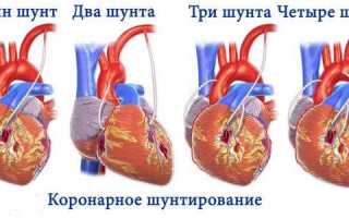 Операции на сердце какие бывают