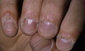 Бородавки на руках: причины и лечение в домашних условиях