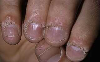 Бородавки на руках: причины и лечение в домашних условиях