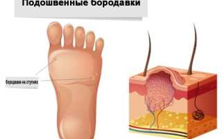 Подошвенная бородавка: причины и лечение в домашних условиях
