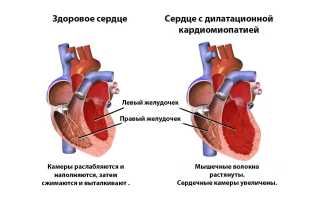Дкмп диагноз
