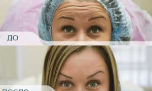 Ботокс в лоб: польза и противопоказания, возможные последствия, сколько держится результат