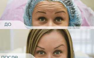 Ботокс в лоб: польза и противопоказания, возможные последствия, сколько держится результат