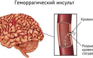 Обширный инсульт последствия шансы выжить реабилитация