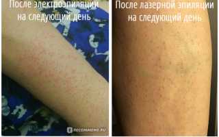 Электроэпиляция или лазер: что выбрать?