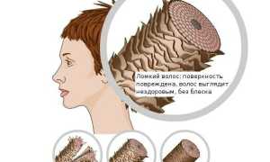 Диффузное выпадение волос: причины и способы лечения