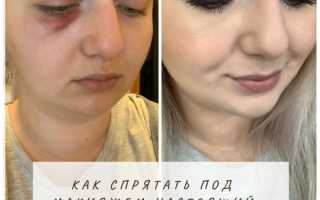 Как избавиться от синяков – нейтрализуем травму