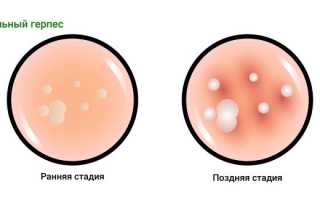 Жжение во влагалище – причины раздражения слизистой