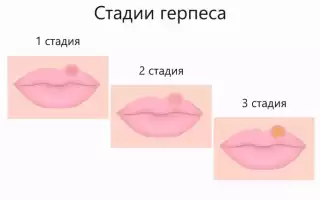 Лечение герпеса на губах: своевременная помощь