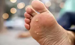 Как можно избавиться от сухой мозоли на ноге в домашних условиях