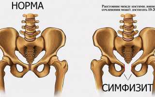 При беременности болит лобковая кость – является ли это осложнением?