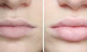 9 лучших филлеров для губ: правила выбора препарата