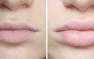 9 лучших филлеров для губ: правила выбора препарата