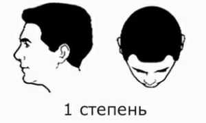 Причины и методы лечения облысения у мужчин