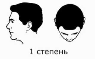 Причины и методы лечения облысения у мужчин