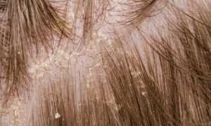 Причины, симптомы и лечение перхоти в домашних условиях