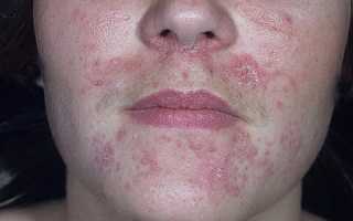 Покраснение и шелушение кожи на лице: причины и лечение