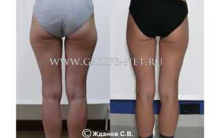 Как убрать галифе: что нужно знать обязательно