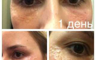 Уколы гиалуроновой кислоты – решение многих проблем