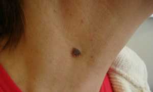 Почему появляются папилломы на шее и как от них избавиться