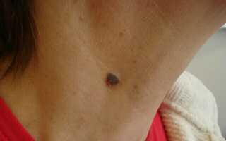 Почему появляются папилломы на шее и как от них избавиться