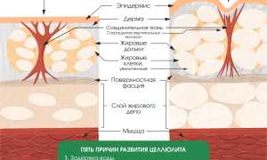 Почему появляется целлюлит: основные причины