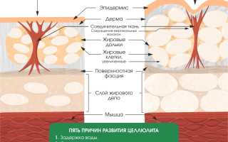 Почему появляется целлюлит: основные причины
