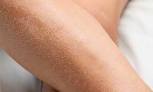 Причины и лечение шелушения кожи на руках и ногах