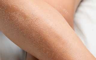 Причины и лечение шелушения кожи на руках и ногах