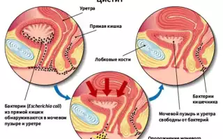 Воспаление мочевого пузыря — почему его не стоит лечить самостоятельно?