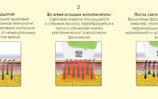 Фотоэпиляция в домашних условиях — удобнее, дешевле… опаснее