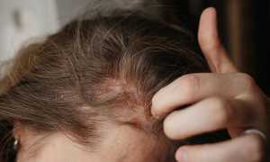 Зуд головы без перхоти: возможные причины и способы лечения