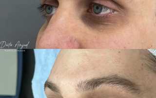 Лечение тёмных кругов под глазами и мужчин