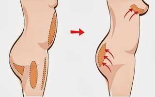 Липофилинг грудных желез — суть процедуры, результат, безопасность