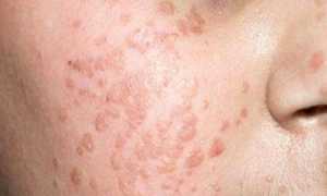 Самые эффективные способы удаления папиллом на лице и голове