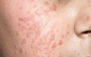 Самые эффективные способы удаления папиллом на лице и голове