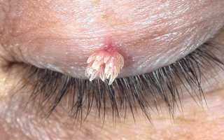 Папиллома на веке: эффективные способы удаления