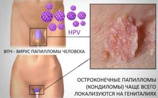 Удаление кондиломы в домашних условиях: стоит ли экспериментировать?