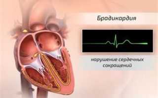 Брадикардия у плода