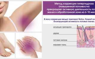 Лечение гипергидроза — современные методы