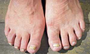 Лечение грибка ногтей уксусом в домашних условиях: лучшие средства