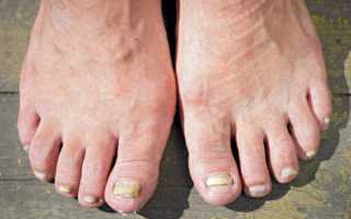 Лечение грибка ногтей уксусом в домашних условиях: лучшие средства