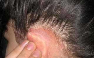Что делать, если шелушится и чешется кожа на голове?