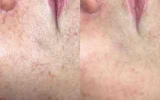Как лечить купероз на лице и можно ли от него избавиться?