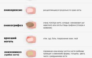 Заболевания ногтей — причины, симптомы, лечение