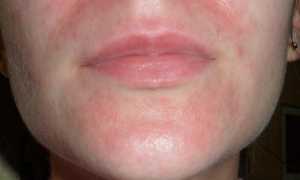Что делать, если чешется лицо: возможные причины и методы терапии