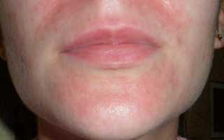 Что делать, если чешется лицо: возможные причины и методы терапии