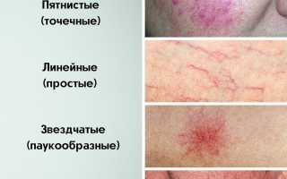 Купероз на лице – признак заболевания внутренних органов